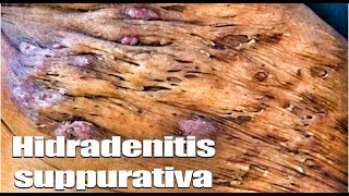 Hidradenitis Suppuritiva  Treatment Prevention and Causes of HS [upl. by Aennaej]