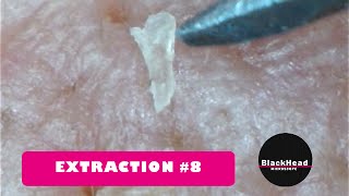 Whitehead and BlackHead RemovalExtraction 8 New One [upl. by Sauder]