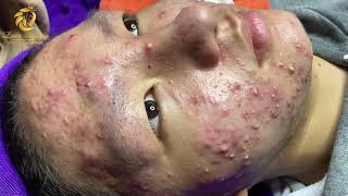 Treatment of acne tablets pustules and blackheads 358  Loan Nguyen [upl. by Behlau]