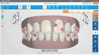 ClinCheck Pro Correção A P e Linha Média  Sistema Invisalign  Blumenau SC [upl. by Juline]