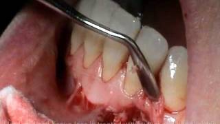 Atlanta Periodontist Georgia GA Cyst Removal Bone Grafting Surgery [upl. by Oirevlis]