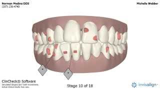 Invisalign Clincheck [upl. by Lemhar]