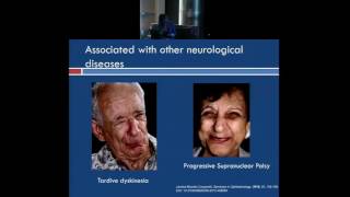 Overview of Blepharospasm and Other Neurological Eye Disorders [upl. by Ahsats]