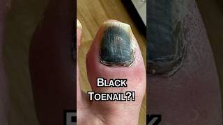 Why is my TOENAIL BLACK 😳 [upl. by Gass]