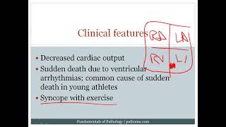 8 6 Cardiomyopathy 8 7 Cardiac Tumors [upl. by Nadroj592]