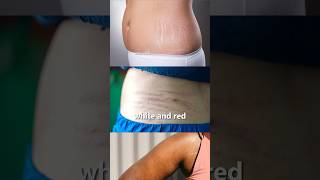 Stretch marks removal cream dermatologist recommended shorts viralshorts [upl. by Wamsley988]