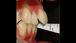 Non Surgical Orthodontic treatment of Skeletal Class II with 7mm Overjet [upl. by Akierdna]