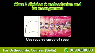 orthodontics treatment planning Part 4 Class 2 div 2 malocclusion Orthodontic Courses Lecture [upl. by Nylirek]