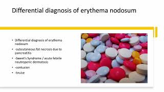 Medical Zone  Differential Diagnosis of Erythema Nodosum [upl. by Gerardo843]