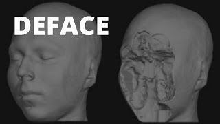 Anonymize MRI Scans [upl. by Adnorhs]