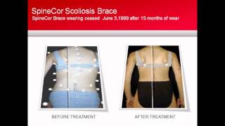 SpineCor Scoliosis Brace Patient Case Study [upl. by Charlet914]