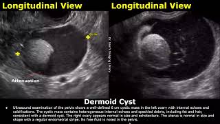 Ovary Ultrasound Reporting  Ovarian Diseases Scan Reports  How To Write USG Report  Pelvic USG [upl. by Nnomae]