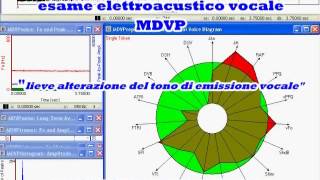 CORDECTOMIA RIABILITAZIONE [upl. by Sergio]