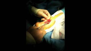 Achilles Tendon Rupture Repair Surgery  Houston Foot Surgeon [upl. by Hackathorn547]