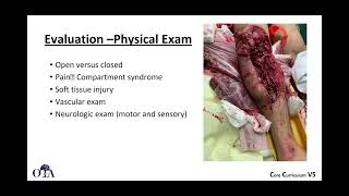 Tibia shaft fractures  1 of 3 [upl. by Barnebas24]