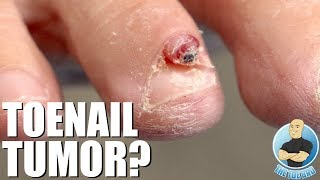 REMOVING A HUGE TOENAIL TUMOR GROWTH [upl. by Esyak287]