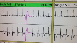 ECG 111 HOLTER CON EXTRASISTOLES VENTRICULARES BIGEMINADAS Y PAREADAS ASOCIADAS ISQUEMIA SILENCI [upl. by Ahsieket]