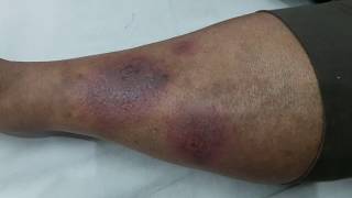 Erythema Nodosum in SLE [upl. by Nrobyalc48]