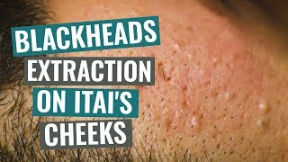 Blackheads extraction on Itais cheeks [upl. by Annwahsal]