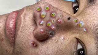 Big Cystic Acne Blackheads Extraction Blackheads amp Milia Whiteheads Removal Pimple Popping 0126 [upl. by Asle]