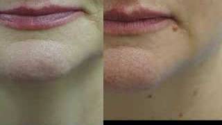 Erbium Laser Resurfacing Before and After Phots [upl. by Loginov]