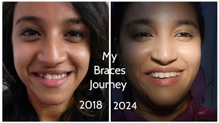 My braces journey in bengali  ceramic braces  Before  After  Is getting braces painful [upl. by Weinberg]