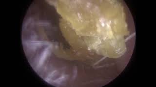 Ear Wax Removal and Dead Skin Removal using Endoscopic Microsuction  330 [upl. by Coralie]