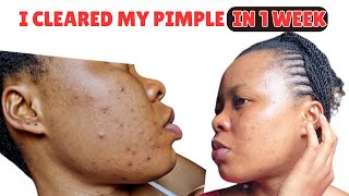 How I Treated My Acne Breakout IN 1 WEEK  Facial Cleanser  Vit c Serum  Face Creamdark spots [upl. by Lenej]