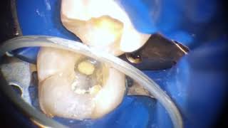 Endodontia Microscópica  dente 37  canal e restauração [upl. by Arualana]