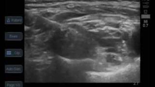 ultrasound guided supraclavicular brachial plexus block [upl. by Decato]