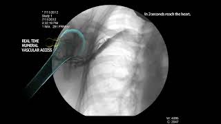 EZ IO Infusion Fluoroscopy Proximal Humerus [upl. by Novah521]