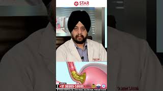 Diffrence Between Hiatus HerniaGERDAcid Reflux in Hindi Hme inme Se Kya Huya Hai kese pta kre [upl. by Nerrak]