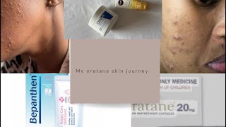 How I cleared my acne with orataneside effectscost amp more oratane cerave nivea [upl. by Daht]