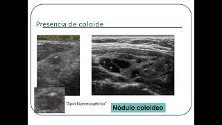 ENDOCRINOLOGÍA 3 Nódulo tiroideo [upl. by Jarib]