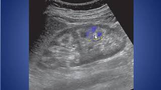 Medullary Nephrocalcinosis Ultrasound [upl. by Byers]