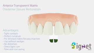 Diastema closure restoration with Signet transparent anterior matrix [upl. by Nelda]