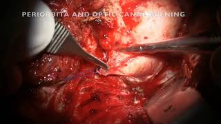 OPTIC NERVE SHEATH MENINGIOMA [upl. by Anizor]