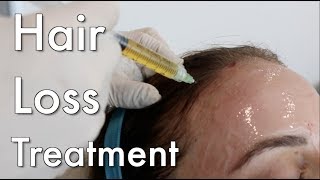 Hair Loss Treatment PRP [upl. by Attolrac314]