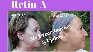 RetinA  My 2 year journey with before and after  Monikas Beauty amp Lifestyle [upl. by Hakaber148]