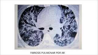 Fisiopatología de la Artritis Reumatoide  Dr Barrantes [upl. by Eihpos]