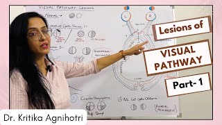 Visual Pathway  Lesions  Part 1 [upl. by Notnarb]