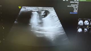 Ultrasound of strangulated umbilical hernia showing omental herniation with fluid [upl. by Eiramalegna211]