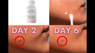 TESTING MARIO BADESCU DRYING LOTION How Many days to get rid of a zit [upl. by Bekki]