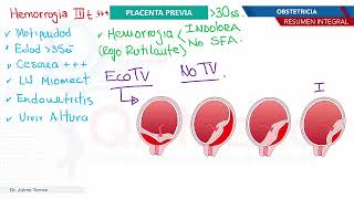 Obstetricia  Placenta previa [upl. by Melvina]