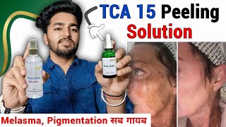 Tca 15 Chemical Peel Review  TCA 15 Peel How to Use  At Home Chemical Peel [upl. by Obadias]