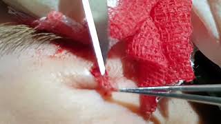 removing intradermal nevus [upl. by Yeknarf]