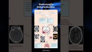 🧠 Fisiopatología de la Hemorragia Subaracnoidea 🧠 CIEMER FOAMed [upl. by Vernier]