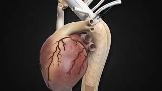 Thoraflex Hybrid Deployment Animation Terumo Aortic [upl. by Ellehcim843]