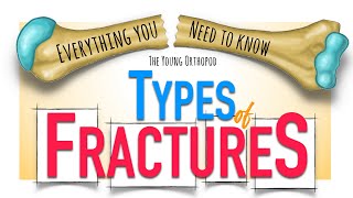 Bone Fracture Types amp Mechanisms  ANIMATION  Fracture classification  The Young Orthopod NEET PG [upl. by Aihsem]