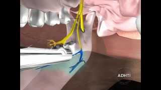 анестезия для блокады язычного нерваanesthesia for lingual nerve blockade [upl. by Enyamart]